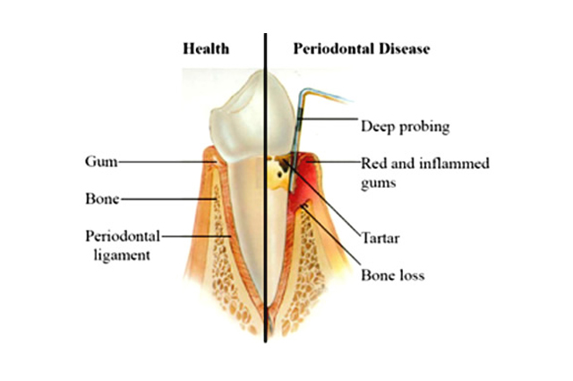 Gum Surgery