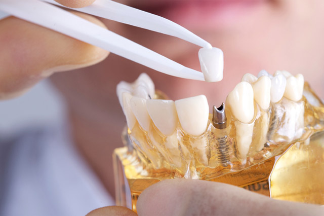 Dental Implant