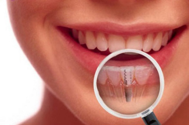 Dental Implant