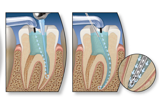 Root Canal Treatment